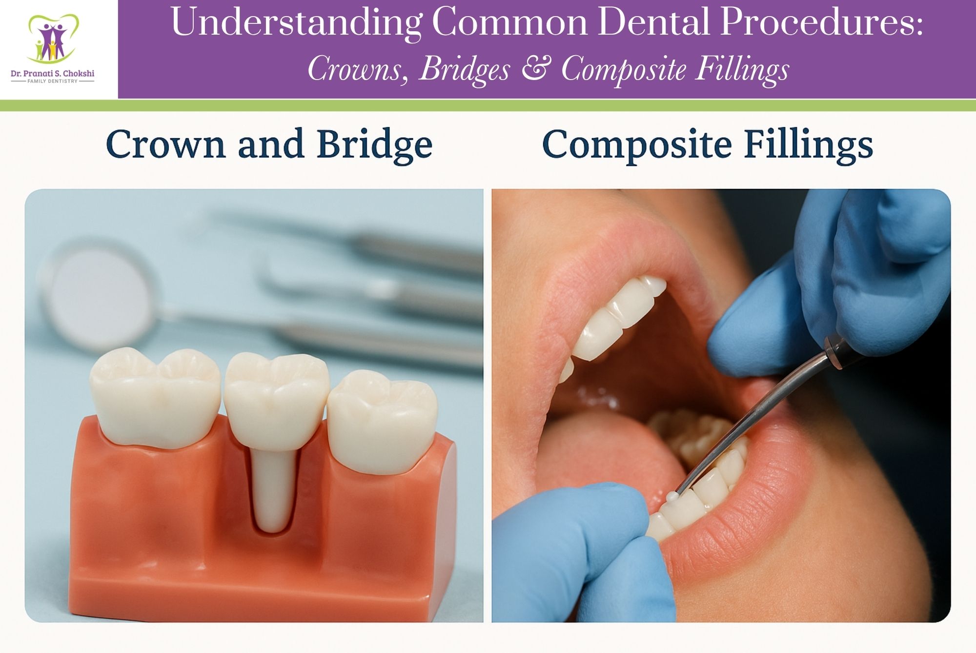 Understanding Common Dental Procedures Crowns, Bridges& Composite Fillings Cropped