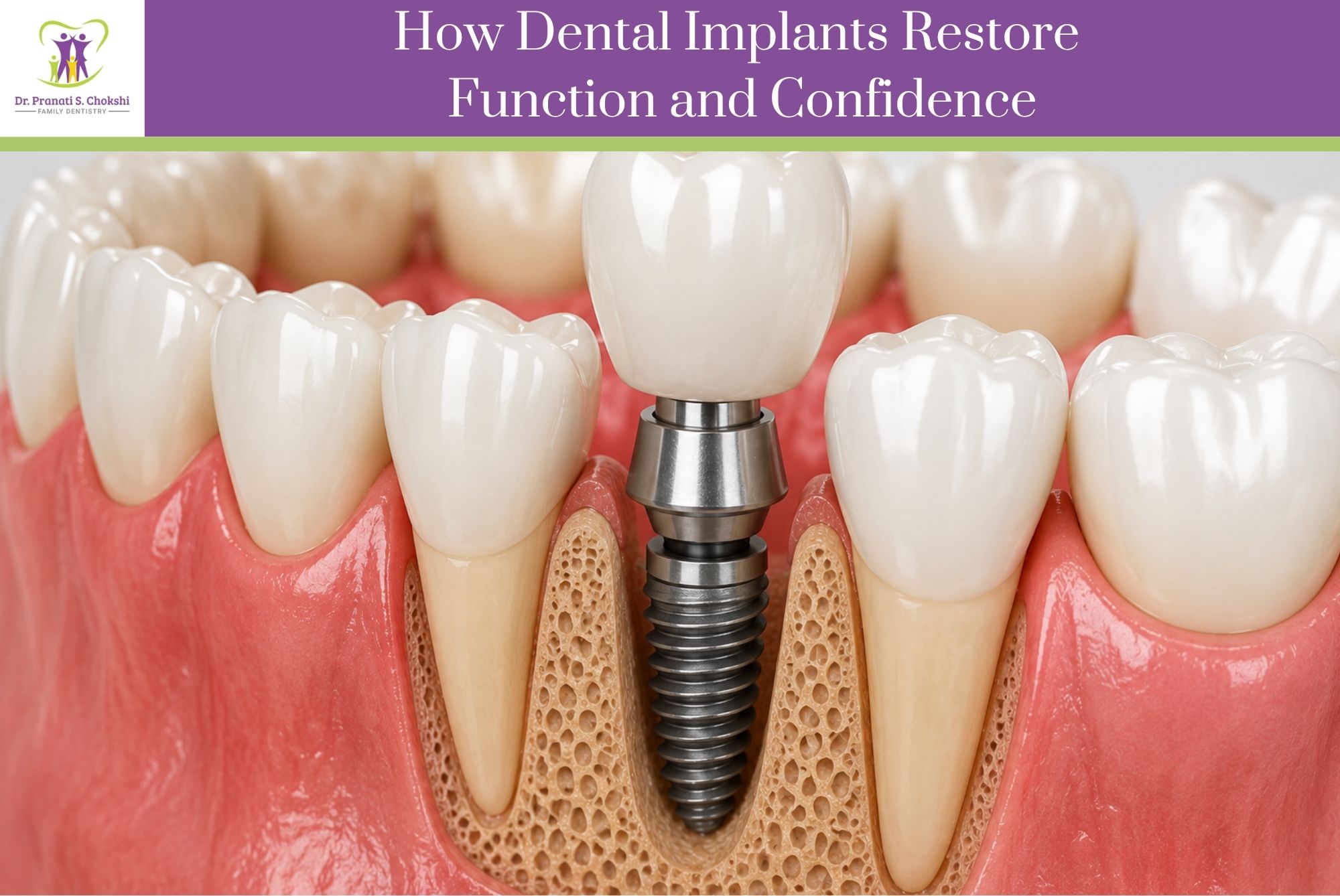 How Dental Implants Restore Function and Confidence | Winter Garden Family and Cosmetic Dentist